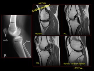 -
MENISCI PCL
ACL
MENISCI PATELLA TENDON
MEDIAL
LATERAL
 