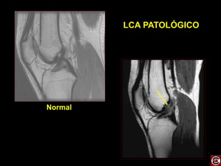 LCA PATOLÓGICO
Normal
 