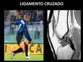 LIGAMENTO CRUZADO
 