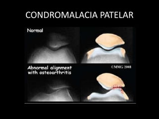 CONDROMALACIA PATELAR
 