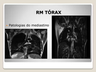 RM TÓRAX
 Patologias do mediastino
 