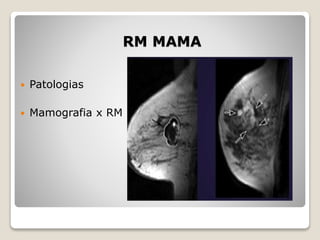 RM MAMA
 Patologias
 Mamografia x RM
 