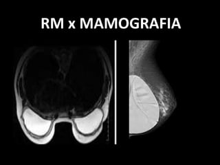 RM x MAMOGRAFIA
 