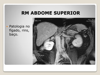 RM ABDOME SUPERIOR
 Patologia no
fígado, rins,
baço.
 