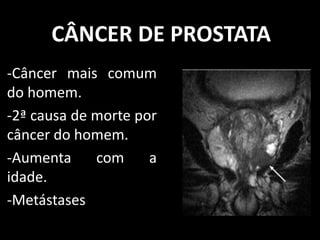 CÂNCER DE PROSTATA
-Câncer mais comum
do homem.
-2ª causa de morte por
câncer do homem.
-Aumenta com a
idade.
-Metástases
 