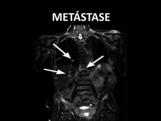 METÁSTASE
 