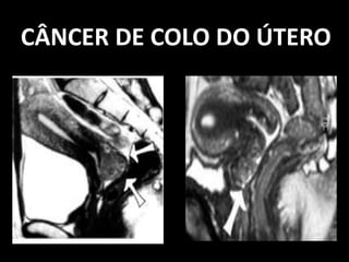 CÂNCER DE COLO DO ÚTERO
 
