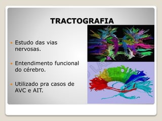 TRACTOGRAFIA
 Estudo das vias
nervosas.
 Entendimento funcional
do cérebro.
 Utilizado pra casos de
AVC e AIT.
 