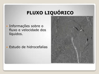 FLUXO LIQUÓRICO
 Informações sobre o
fluxo e velocidade dos
líquidos.
 Estudo de hidrocefalias
 
