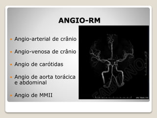 ANGIO-RM
 Angio-arterial de crânio
 Angio-venosa de crânio
 Angio de carótidas
 Angio de aorta torácica
e abdominal
 Angio de MMII
 