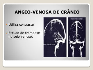 ANGIO-VENOSA DE CRÂNIO
 Utiliza contraste
 Estudo de trombose
no seio venoso.
 
