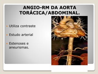 ANGIO-RM DA AORTA
TORÁCICA/ABDOMINAL.
 Utiliza contraste
 Estudo arterial
 Estenoses e
aneurismas.
 