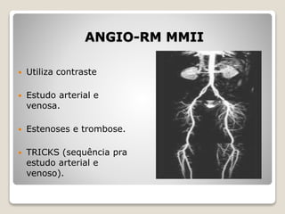 ANGIO-RM MMII
 Utiliza contraste
 Estudo arterial e
venosa.
 Estenoses e trombose.
 TRICKS (sequência pra
estudo arterial e
venoso).
 