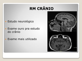 RM CRÂNIO
 Estudo neurológico
 Exame ouro pra estudo
do crânio
 Exame mais utilizado
 