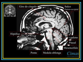 Medula oblongaPonte
Mesencéfalo
Hipófise
Giro do cíngulo Sulco
Parieto-occipital
v.galeno
Pineal
 