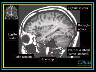 Radiação
óptica
Hipocampo
Cápsula interna
Lobo temporal
Ventrículo lateral
(corno temporal)
Região
insular
 