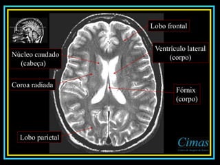 Lobo parietal
Lobo frontal
Ventrículo lateral
(corpo)
Coroa radiada
Núcleo caudado
(cabeça)
Fórnix
(corpo)
 