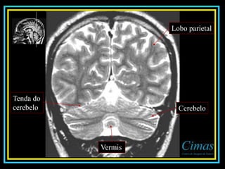 Lobo parietal
Cerebelo
Vermis
Tenda do
cerebelo
 