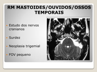 RM MASTOIDES/OUVIDOS/OSSOS
TEMPORAIS
 Estudo dos nervos
cranianos
 Surdez
 Neoplasia trigemial
 FOV pequeno
 