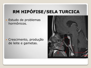 RM HIPÓFISE/SELA TURCICA
 Estudo de problemas
hormônicos.
 Crescimento, produção
de leite e gametas.
 