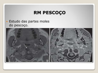 RM PESCOÇO
 Estudo das partes moles
do pescoço.
 