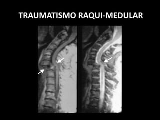 TRAUMATISMO RAQUI-MEDULAR
 