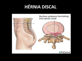 HÉRNIA DISCAL
 