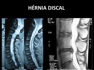 HÉRNIA DISCAL
 