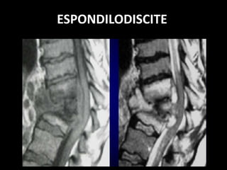 ESPONDILODISCITE
 