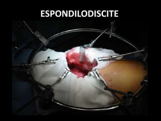 ESPONDILODISCITE
 