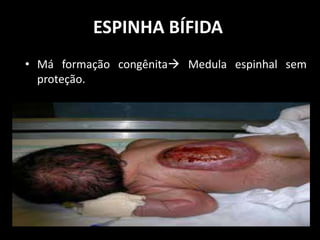 ESPINHA BÍFIDA
• Má formação congênita Medula espinhal sem
proteção.
 