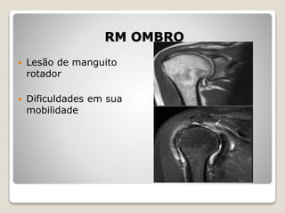 RM OMBRO
 Lesão de manguito
rotador
 Dificuldades em sua
mobilidade
 