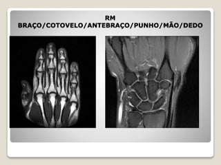 RM
BRAÇO/COTOVELO/ANTEBRAÇO/PUNHO/MÃO/DEDO
 