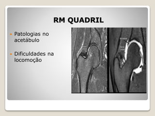 RM QUADRIL
 Patologias no
acetábulo
 Dificuldades na
locomoção
 
