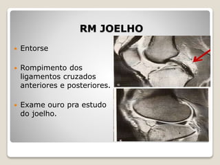RM JOELHO
 Entorse
 Rompimento dos
ligamentos cruzados
anteriores e posteriores.
 Exame ouro pra estudo
do joelho.
 