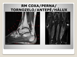 RM COXA/PERNA/
TORNOZELO/ANTEPÉ/HÁLUX
 