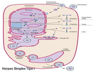Herpes Simplex Tipo I
 