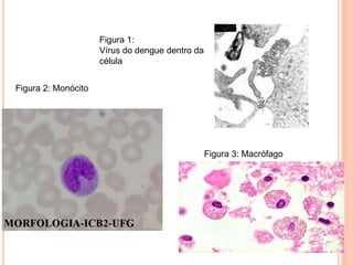 Figura 1:
Vírus do dengue dentro da
célula
Figura 2: Monócito
Figura 3: Macrófago
 