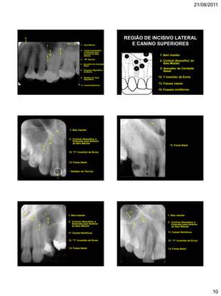 21/08/2011
10
1
5
2
1. Seio Maxilar
5. Processo Zigomático
da Maxila
3
3. “W” Sinusal
6
2. Cortical (Assoalho)
e Extensão para
Alveolar do Seio
Maxilar
6. Sombra do Osso
Zigomático
4. Assoalho da Cavidade
Nasal
4
11. Canais Nutritivos
11
REGIÃO DE INCISIVO LATERAL
E CANINO SUPERIORES
14. Fosseta mirtiforme
13. Fossas nasais
1. Seio maxilar
12. Y invertido de Ennis
4
2
1
12
13
14
2. Cortical (Assoalho) do
Seio Maxilar
4. Assoalho da Cavidade
Nasal
131
12
13. Fossa Nasal
1. Seio maxilar
12. “Y” Invertido de Ennis
2
2. Cortical (Assoalho) e
Extensão para Anterior
do Seio Maxilar
*
* Artefato de Técnica
13
13. Fossa Nasal
13 1
12
13. Fossa Nasal
1. Seio maxilar
12. “Y” Invertido de Ennis
2
2. Cortical (Assoalho) e
Extensão para Anterior
do Seio Maxilar
11. Canais Nutritivos
11
13
1
12
13. Fossa Nasal
1. Seio maxilar
12. “Y” Invertido de Ennis
2
2. Cortical (Assoalho) e
Extensão para Anterior
do Seio Maxilar
11. Canais Nutritivos
11
 
