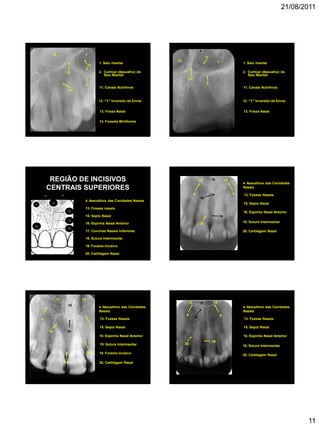 21/08/2011
11
14. Fosseta Mirtiforme
14
13 1
12
13. Fossa Nasal
1. Seio maxilar
12. “Y” Invertido de Ennis
2
2. Cortical (Assoalho) do
Seio Maxilar
11. Canais Nutritivos
11
13 1
12
13. Fossa Nasal
1. Seio maxilar
12. “Y” Invertido de Ennis
2
2. Cortical (Assoalho) do
Seio Maxilar
11. Canais Nutritivos
11
REGIÃO DE INCISIVOS
CENTRAIS SUPERIORES
4. Assoalhos das Cavidades Nasais
13. Fossas nasais
15. Septo Nasal
16. Espinha Nasal Anterior
17. Conchas Nasais Inferiores
18. Sutura Intermaxilar
19. Forame Incisivo
20. Cartilagem Nasal
15
4
16
19
18
13 17
20
13 13
13. Fossas Nasais
16
16. Espinha Nasal Anterior
18
18. Sutura Intermaxilar
15
15. Septo Nasal
4. Assoalhos das Cavidades
Nasais
4 4
20
20. Cartilagem Nasal
13 13
13. Fossas Nasais
16
16. Espinha Nasal Anterior
18
18. Sutura Intermaxilar
15
15. Septo Nasal
4. Assoalhos das Cavidades
Nasais
4
4
20 19. Forame Incisivo
19
20. Cartilagem Nasal
13 13
13. Fossas Nasais16
16. Espinha Nasal Anterior
18
18. Sutura Intermaxilar
15
15. Septo Nasal
4. Assoalhos das Cavidades
Nasais
4 4
20
20. Cartilagem Nasal
 