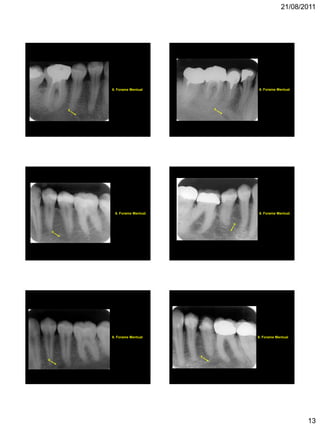 21/08/2011
13
6
6. Forame Mentual
6
6. Forame Mentual
6
6. Forame Mentual
6
6. Forame Mentual
6
6. Forame Mentual
6
6. Forame Mentual
 