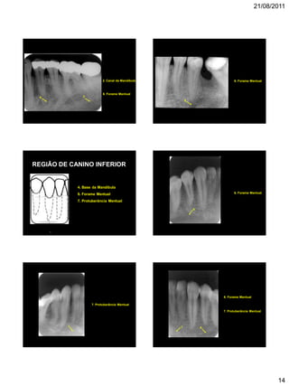 21/08/2011
14
6
2. Canal da Mandíbula
2
6. Forame Mentual
6
6. Forame Mentual
REGIÃO DE CANINO INFERIOR
4. Base da Mandíbula
6. Forame Mentual
7. Protuberância Mentual
7
6
6. Forame Mentual
7
7. Protuberância Mentual
7
7. Protuberância Mentual
6
6. Forame Mentual
 