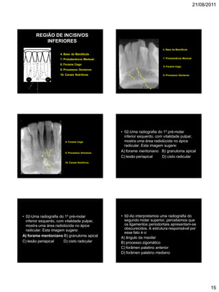 21/08/2011
15
REGIÃO DE INCISIVOS
INFERIORES
4. Base da Mandíbula
7. Protuberância Mentual
8. Forame Cego
9. Processos Genianos
10. Canais Nutritivos
10
10
7
8
9
4
8. Forame Cego
7. Protuberância Mentual
4. Base da Mandíbula
87
4
9
9. Processos Genianos
8. Forame Cego
8
9
9. Processos Genianos
10
10. Canais Nutritivos
• 02-Uma radiografia do 10 pré-molar
inferior esquerdo, com vitalidade pulpar,
mostra uma área radiolúcida no ápice
radicular. Esta imagem sugere:
A) forame mentoniano B) granuloma apical
C) lesão periapical D) cisto radicular
• 02-Uma radiografia do 10 pré-molar
inferior esquerdo, com vitalidade pulpar,
mostra uma área radiolúcida no ápice
radicular. Esta imagem sugere:
A) forame mentoniano B) granuloma apical
C) lesão periapical D) cisto radicular
• 92-Ao interpretamos uma radiografia do
segundo molar superior, percebemos que
os ligamentos periodontais apresentam-se
obscurecidos. A estrutura responsável por
esse fato é o:
A) ângulo da maxilar
B) processo zigomático
C) forâmen palatino anterior
D) forâmen palatino mediano
 