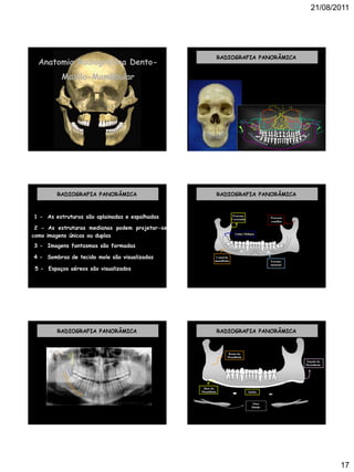21/08/2011
17
Anatomia Radiográfica Dento-
Maxilo-Mandibular
RADIOGRAFIA PANORÂMICA
RADIOGRAFIA PANORÂMICA
1 - As estruturas são aplainadas e espalhadas
2 - As estruturas medianas podem projetar-se
como imagens únicas ou duplas
3 - Imagens fantasmas são formadas
4 - Sombras de tecido mole são visualizadas
5 - Espaços aéreos são visualizados
Canal
mandibular
Processo
Coronóide
Forame
mentual
Processo
condilar
Linha Obliqua
Canal da
mandíbula
RADIOGRAFIA PANORÂMICA
RADIOGRAFIA PANORÂMICA
Base da
Mandíbula
Ramo da
Mandíbula
Ângulo da
Mandíbula
Sínfise
Osso
Hióide
RADIOGRAFIA PANORÂMICA
 