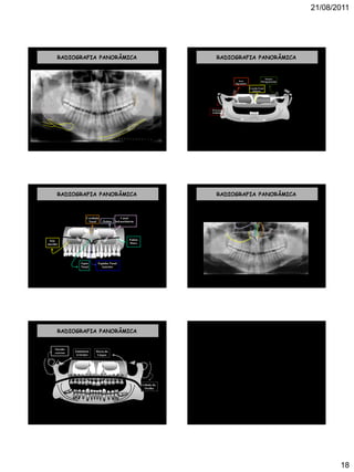 21/08/2011
18
RADIOGRAFIA PANORÂMICA RADIOGRAFIA PANORÂMICA
Arco
Zigomático
Concha Nasal
Inferior
Processo
Estilóide
Fissura
Pterigomaxilar
RADIOGRAFIA PANORÂMICA
Seio
maxilar
Cavidade
Nasal Órbita
Palato
Duro
Espinha Nasal
Anterior
Septo
Nasal
Canal
Infraorbitário
RADIOGRAFIA PANORÂMICA
RADIOGRAFIA PANORÂMICA
Dorso da
Língua
Lóbulo da
Orelha
Eminência
Articular
Ouvido
externo
 
