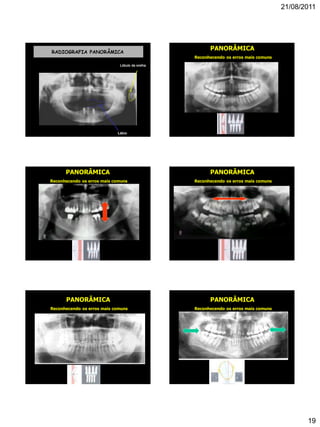 21/08/2011
19
RADIOGRAFIA PANORÂMICA
Lábio
Lóbulo da orelha
PANORÂMICA
Reconhecendo os erros mais comuns
PANORÂMICA
Reconhecendo os erros mais comuns
PANORÂMICA
Reconhecendo os erros mais comuns
PANORÂMICA
Reconhecendo os erros mais comuns
PANORÂMICA
Reconhecendo os erros mais comuns
 