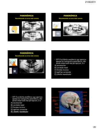 21/08/2011
20
PANORÂMICA
Reconhecendo os erros mais comuns
PANORÂMICA
Reconhecendo os erros mais comuns
PANORÂMICA
Reconhecendo os erros mais comuns
• 107-0 acidente anatômico que aparece
apenas na radiografia panorâmica, não
sendo observado nas periapicais, é o:
A) seiomaxilar
B) cavidade nasal
C) forame incisivo
D) apófise coronoide
E) côndilo mandibular
• 107-0 acidente anatômico que aparece
apenas na radiografia panorâmica, não
sendo observado nas periapicais, é o:
A) seiomaxilar
B) cavidade nasal
C) forame incisivo
D) apófise coronoide
E) côndilo mandibular
TELERRADIOGRAFIA LATERAL
Sutura escamosa
Sutura
lambdóide
Frontal
Sutura coronal
Glabela
Esfenóide
Temporal
Ouvido
externo
Arco supraciliar
Parietal
Arco zigomático
Processo zigomático
do temporal
Maxila
Mandíbula
Forame mentual
Osso
lacrimal
ENA
Occipital
 