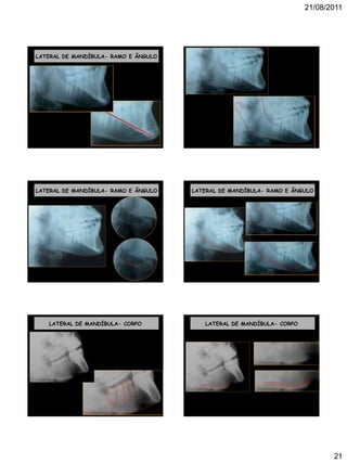 21/08/2011
21
LATERAL DE MANDÍBULA- RAMO E ÂNGULO
LATERAL DE MANDÍBULA- RAMO E ÂNGULO LATERAL DE MANDÍBULA- RAMO E ÂNGULO
LATERAL DE MANDÍBULA- CORPO LATERAL DE MANDÍBULA- CORPO
 