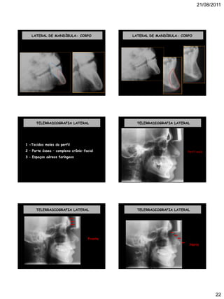 21/08/2011
22
LATERAL DE MANDÍBULA- CORPO LATERAL DE MANDÍBULA- CORPO
TELERRADIOGRAFIA LATERAL
1 -Tecidos moles do perfil
2 – Parte óssea – complexo crânio-facial
3 – Espaços aéreos faríngeos
TELERRADIOGRAFIA LATERAL
Perfil mole
TELERRADIOGRAFIA LATERAL
Fronte
TELERRADIOGRAFIA LATERAL
Nariz
 