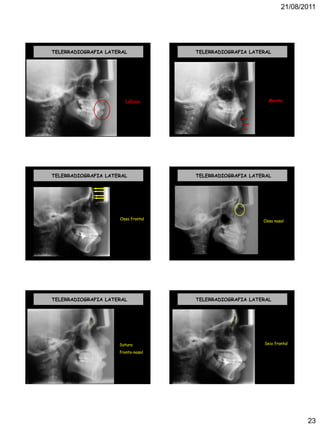 21/08/2011
23
TELERRADIOGRAFIA LATERAL
Lábios
TELERRADIOGRAFIA LATERAL
Mento
TELERRADIOGRAFIA LATERAL
Osso frontal
TELERRADIOGRAFIA LATERAL
Osso nasal
TELERRADIOGRAFIA LATERAL
Sutura
fronto-nasal
...
TELERRADIOGRAFIA LATERAL
Seio frontal
 